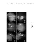 FUNCTIONAL NEAR-INFRARED FLUORESCENCE LYMPHATIC MAPPING FOR DIAGNOSING, ACCESSING, MONITORING AND DIRECTING THERAPY OF LYMPHATIC DISORDERS diagram and image