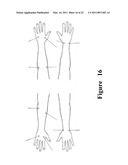 FUNCTIONAL NEAR-INFRARED FLUORESCENCE LYMPHATIC MAPPING FOR DIAGNOSING, ACCESSING, MONITORING AND DIRECTING THERAPY OF LYMPHATIC DISORDERS diagram and image