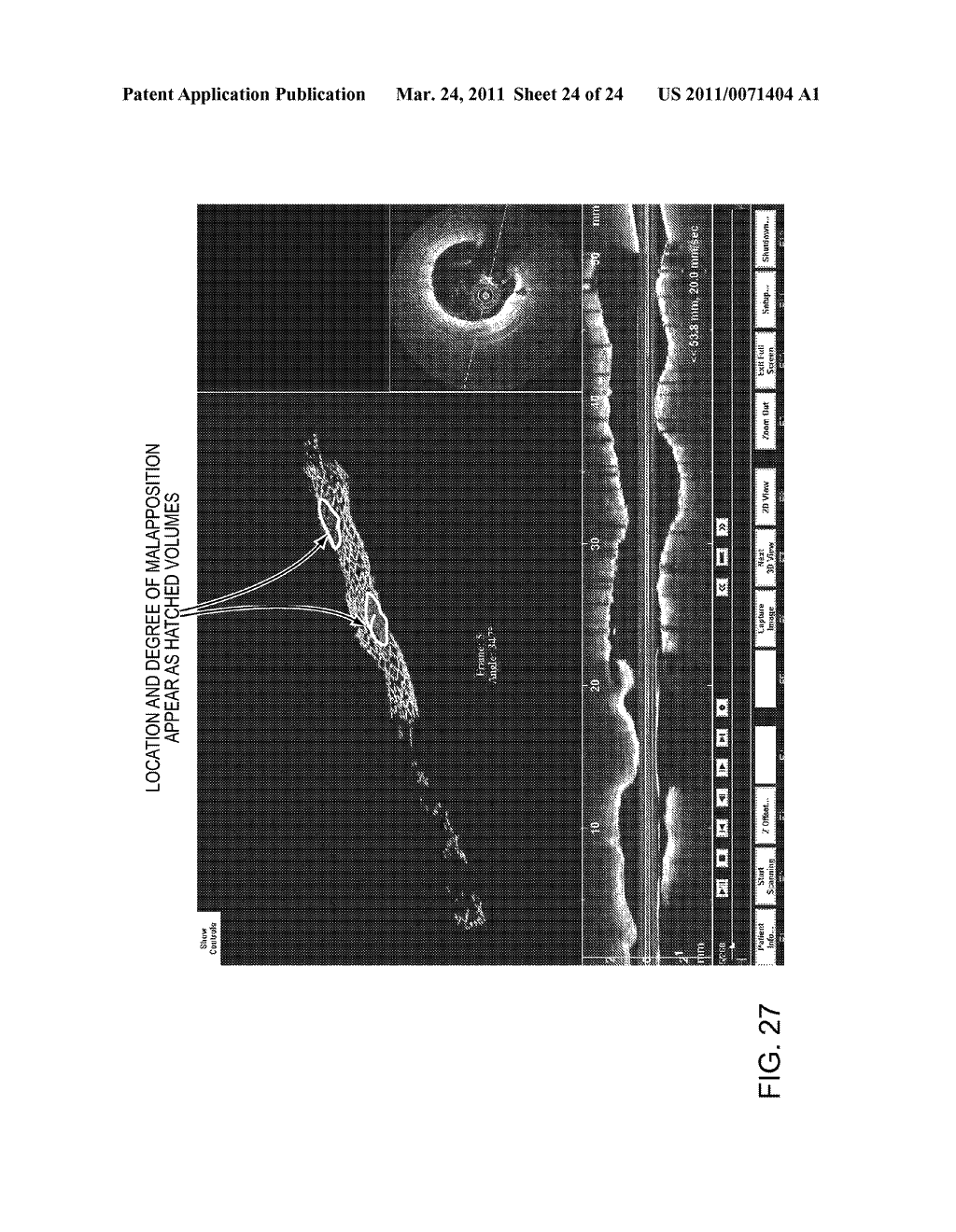 Lumen Morphology and Vascular Resistance Measurements Data Collection Systems, Apparatus and Methods - diagram, schematic, and image 25