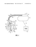 MORPHOLOGY BASED ISCHEMIA DETECTION USING INTRACARDIAC ELECTROGRAMS diagram and image