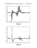 MORPHOLOGY BASED ISCHEMIA DETECTION USING INTRACARDIAC ELECTROGRAMS diagram and image