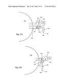 Glaucoma Drainage Device with Pump diagram and image