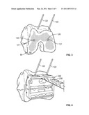 Patient-Specific Orthopedic Instruments diagram and image