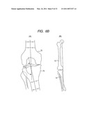 Intramedullary Rod for Assisting Total Knee Joint Replacing Operation and Method for Controle Operation Using the Rod diagram and image