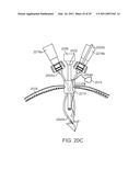 CURVED CANNULA diagram and image