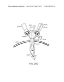 CURVED CANNULA SURGICAL SYSTEM CONTROL diagram and image