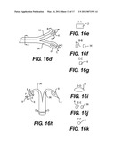 Suture Passing Devices and Methods diagram and image