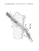 ARTICULATING SUTURING DEVICE AND METHOD diagram and image