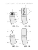 IMPLANTABLE RESTRICTION SYSTEM TENSION RELEASE MECHANISM diagram and image