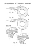 IMPLANTABLE RESTRICTION SYSTEM TENSION RELEASE MECHANISM diagram and image