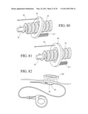 IMPLANTABLE RESTRICTION SYSTEM TENSION RELEASE MECHANISM diagram and image