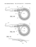 IMPLANTABLE RESTRICTION SYSTEM TENSION RELEASE MECHANISM diagram and image