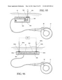 IMPLANTABLE RESTRICTION SYSTEM TENSION RELEASE MECHANISM diagram and image