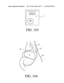 IMPLANTABLE RESTRICTION SYSTEM TENSION RELEASE MECHANISM diagram and image