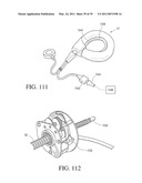 IMPLANTABLE RESTRICTION SYSTEM TENSION RELEASE MECHANISM diagram and image