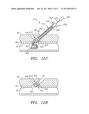 APPARATUS AND METHODS FOR PROVIDING TACTILE FEEDBACK WHILE DELIVERING A CLOSURE DEVICE diagram and image