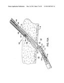 ARTICULATING SUTURING AND DEVICE AND METHOD diagram and image