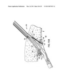 ARTICULATING SUTURING AND DEVICE AND METHOD diagram and image