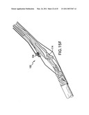 ARTICULATING SUTURING AND DEVICE AND METHOD diagram and image