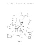 COUPLINGS FOR IMPLANTED LEADS AND EXTERNAL STIMULATORS, AND ASSOCIATED SYSTEMS AND METHODS diagram and image