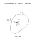 MEDICAL PROBE WITH TRANSLATABLE CO-ACCESS CANNULA diagram and image