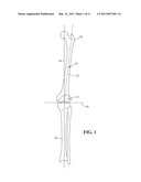 EXPANDABLE INTRAMEDULLARY ROD diagram and image