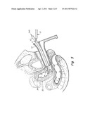 CERVICAL OCCLUDER diagram and image