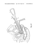 CERVICAL OCCLUDER diagram and image