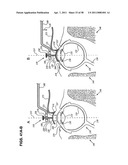 METHODS AND DEVICES FOR ORTHOVOLTAGE OCULAR RADIOTHERAPY AND TREATMENT PLANNING diagram and image