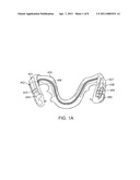 INTRAORAL APPLIANCE FOR SOUND TRANSMISSION VIA BONE CONDUCTION diagram and image