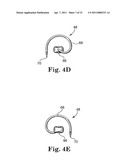 MINIMALLY INVASIVE LEVATOR AVULSION REPAIR diagram and image