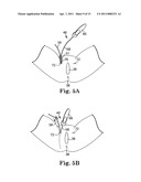 MINIMALLY INVASIVE LEVATOR AVULSION REPAIR diagram and image