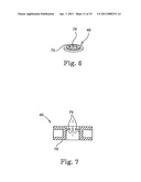 MINIMALLY INVASIVE LEVATOR AVULSION REPAIR diagram and image