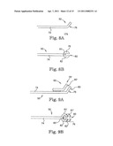 MINIMALLY INVASIVE LEVATOR AVULSION REPAIR diagram and image