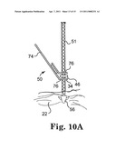 MINIMALLY INVASIVE LEVATOR AVULSION REPAIR diagram and image