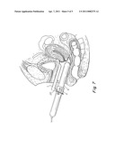 TRANSVAGINAL ULTRASOUND PROBE SPECULUM diagram and image