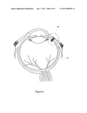 METHOD FOR IMPLANTING INTRAOCULAR PRESSURE SENSOR diagram and image