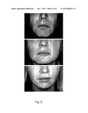 METHODS FOR MEASURING CHANGE IN LIP SIZE AFTER AUGMENTATION diagram and image