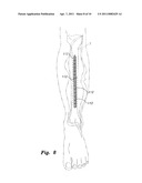 BIOINJECTION DEVICE diagram and image