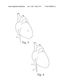 CARDIAC ABLATION SYSTEM WITH PULSED AIMING LIGHT diagram and image