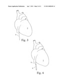 CARDIAC ABLATION SYSTEM WITH INFLATABLE MEMBER HAVING MULTIPLE INFLATION SETTINGS diagram and image