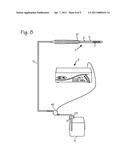 Cryosurgical System diagram and image