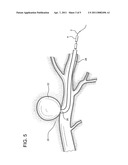 Endovascular device and clotting system for the repair of vascular defects and malformations diagram and image