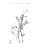 Endovascular device and clotting system for the repair of vascular defects and malformations diagram and image