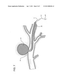 Endovascular device and clotting system for the repair of vascular defects and malformations diagram and image