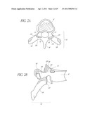 VERTEBRAL FACET JOINT PROSTHESIS AND METHOD OF FIXATION diagram and image