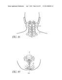 VERTEBRAL FACET JOINT PROSTHESIS AND METHOD OF FIXATION diagram and image