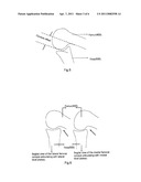 ARTIFICIAL KNEE JOINT diagram and image