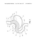 STOMACH BYPASS FOR THE TREATMENT OF OBESITY diagram and image