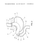 STOMACH BYPASS FOR THE TREATMENT OF OBESITY diagram and image